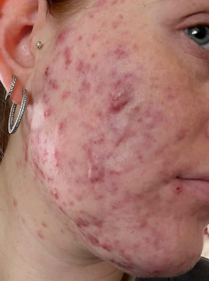 Before-and-after split screen comparison of a woman's face showing improvement in acne and redness on her cheek and jawline.