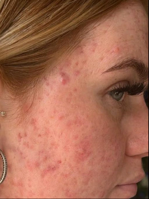 Before-and-after split screen comparison of a woman's face showing improvement in acne and redness on her cheek and jawline.