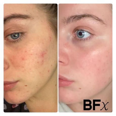 BFx Before and after