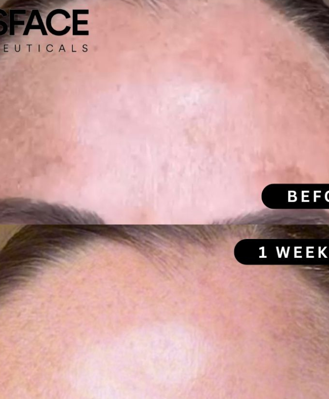 pigmentation blog post