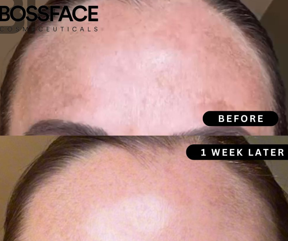 pigmentation blog post